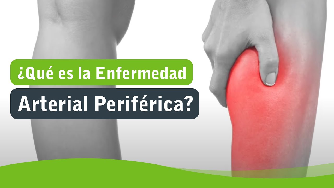 Consejos Y Tratamientos Naturales Para La Enfermedad Arterial Perif Rica