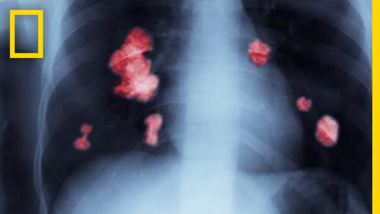 ¿Cómo Prevenir y Tratar la Obesidad? Los Pasos para Vencer una Enfermedad Común